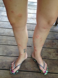 sandfly legs